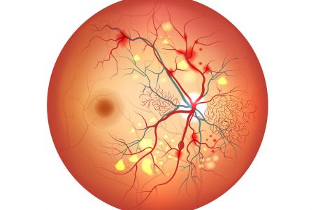 La rétinopathie diabétique
